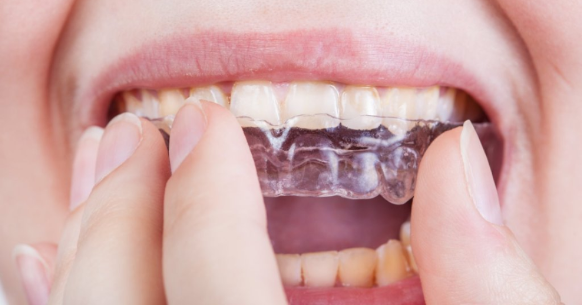 kleding stof Briesje Herstellen Tandenknarsen? Niet alleen naar de tandarts, maar ook naar de fysio | CTI  Warmond