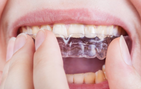Tandenknarsen? Niet alleen naar de tandarts, maar ook fysio | CTI